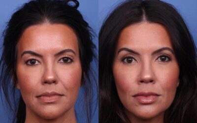 Eyelid Surgery Cost in Cape Town: What’s Included and What to Watch Out For
