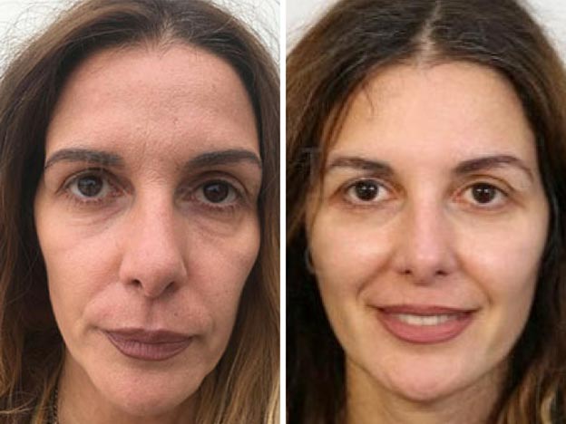 Non Surgical Facelift vs Surgical Facelift
