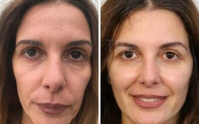 Non-Surgical Facelift vs Surgical Facelift: Which One Is Right for You in Cape Town?